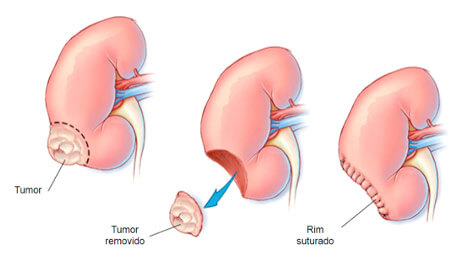 Urologia Reconstrutiva - Dr. Júlio José Geminiani > Tratamentos