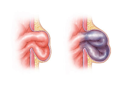 Hérnia inguinal nos praticantes de musculação - Hernia Clinic