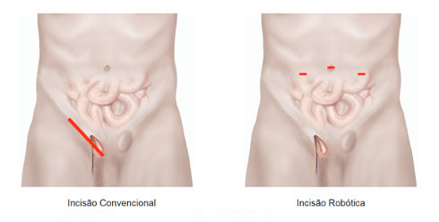 Hérnia na virilha ou inguinal – Dr. Leonardo Rodovalho – Cirurgia geral –  Saúde do homem