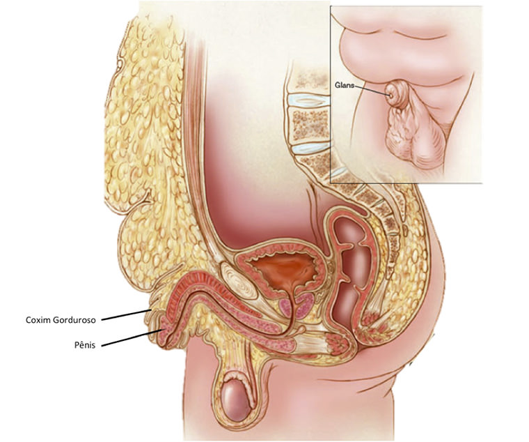 Pênis Escondido ou Escarcerado Imagem 1
